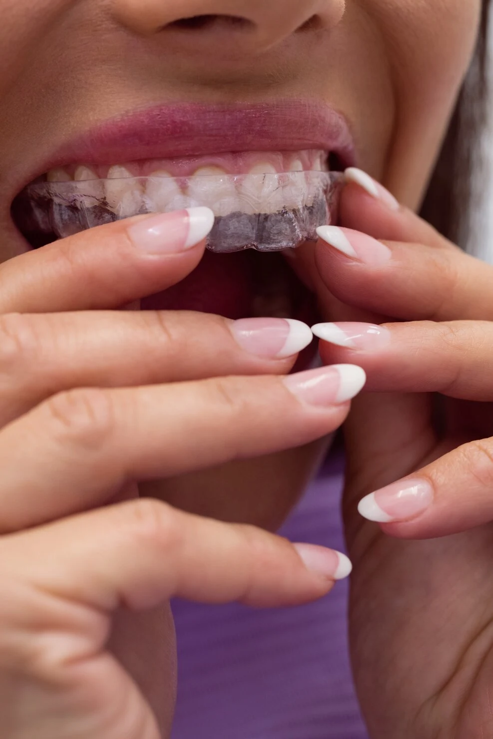 Our Invisalign