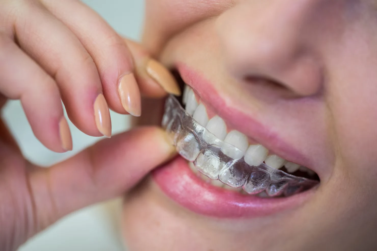 Invisalign Kitchener